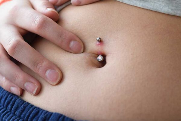 https://www.healthline.com/health/body-modification/keloid-belly-button-piercing#:~:text=Keloids%20are%20overgrowths%20of%20scar,be%20annoying%20and%20occasionally%20painful.