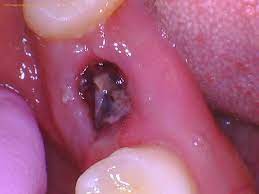 food stuck in wisdom tooth hole can't get it out